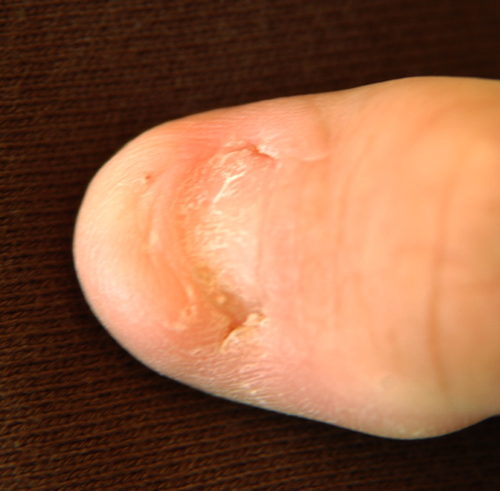 Nailpatellakleur1fotojanwij
