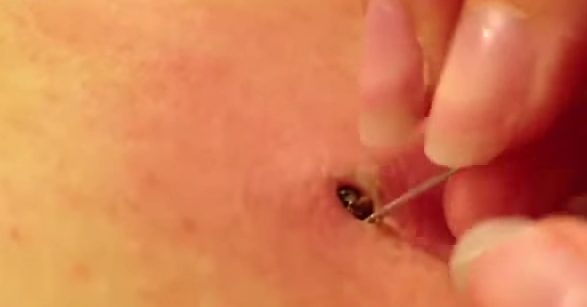 Watch The Insane Removal Of This 25-Year-Old Blackhead