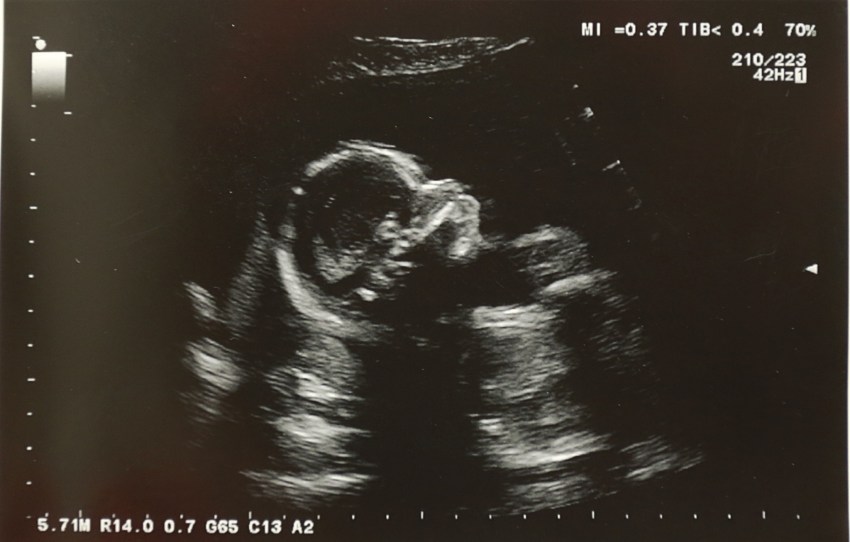 My Wife And I Were Really Excited To Become Parents — That Is, Until We Saw The Ultrasound