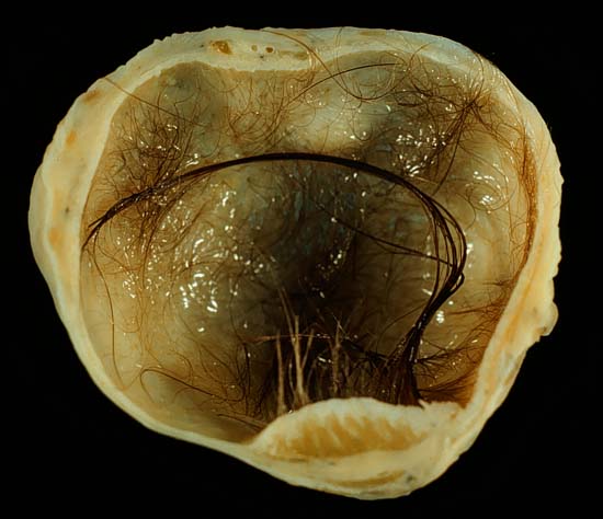 Ovarian teratoma via Wiki Commons