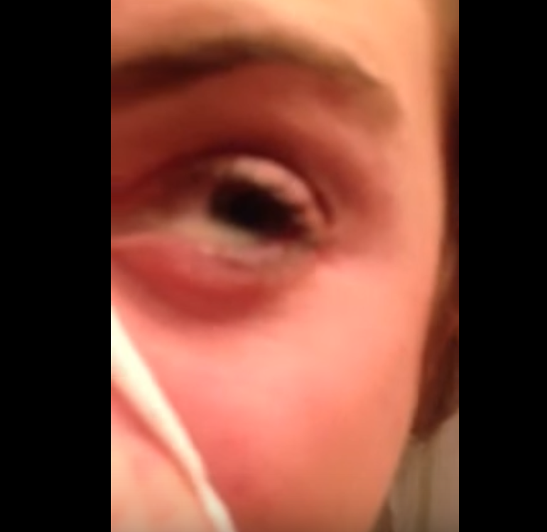 Mucus coming out of eye!!! / Brett Larose (Youtube)