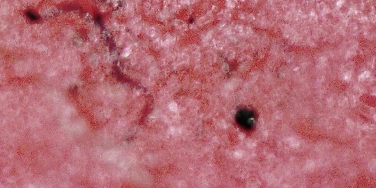 Morgellons Disease: Is It Real, Or Just Really Crazy?