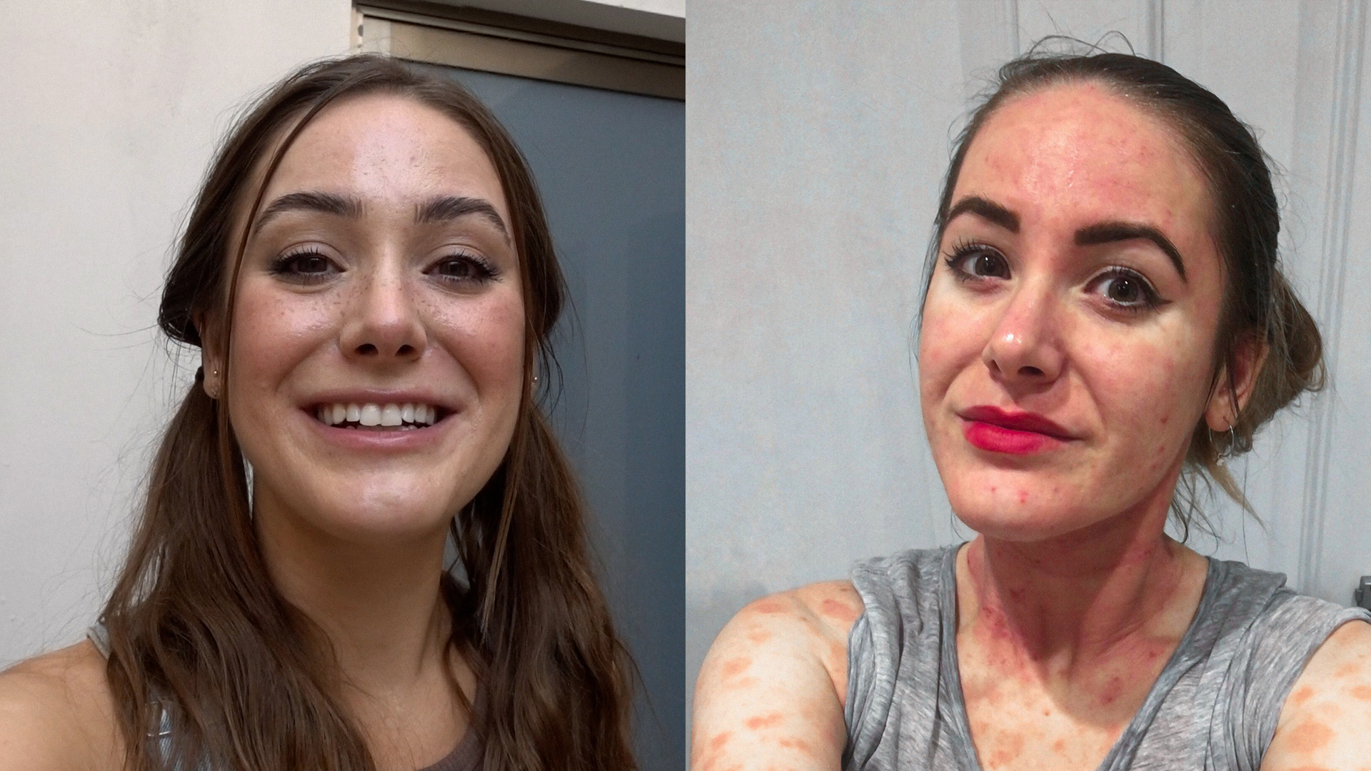 Finding Beauty In The Struggle With Eczema Advocate, Sabina Trojanova